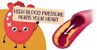 High Arterial Pressure  Understanding and Managing the Condition
